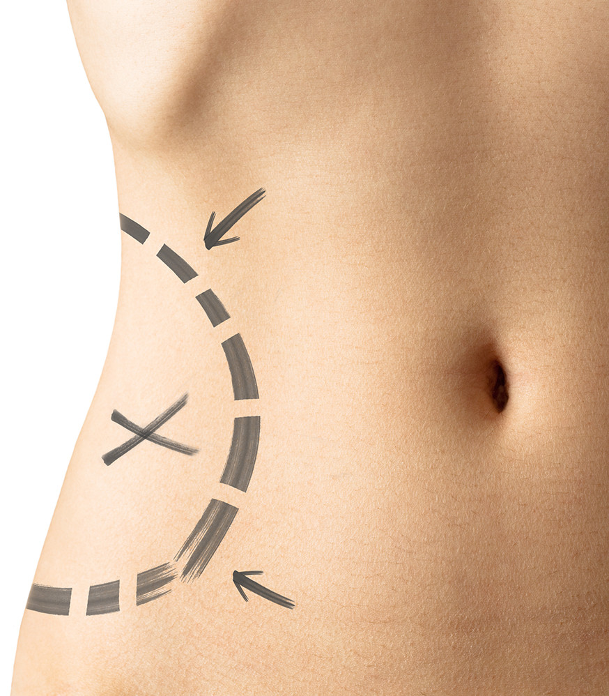 liposuction fat transfer tummy tuck butt lift brazilian procedures still diet